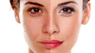 Expert Tips for Minimizing Aging Spots