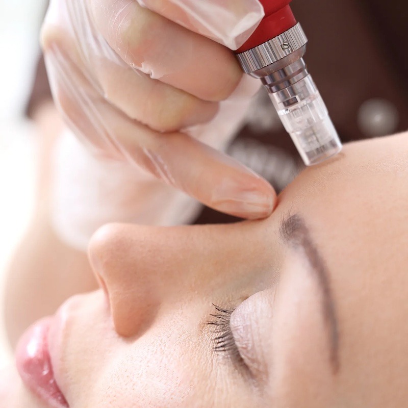Templum aesthetics & Wellness Microneedling