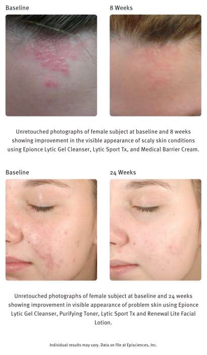 EPIONCE LYTIC GEL CLEANSER ($40) - Image 2