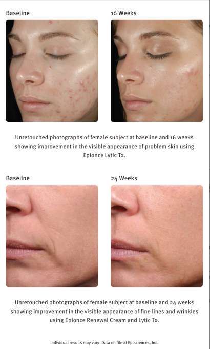 EPIONCE LYTIC TX ($56) - Image 2