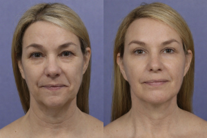 Laser Skin Resurfacing Before And After - Templum Aesthetics & Wellness