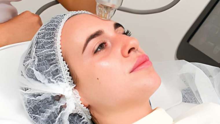 MicroLaser Peel