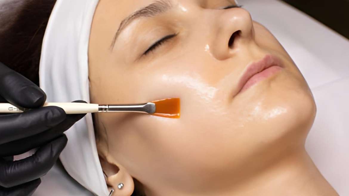 Perfect Derma Peel