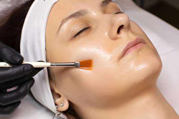Perfect Derma Peel Treatment Seattle, WA